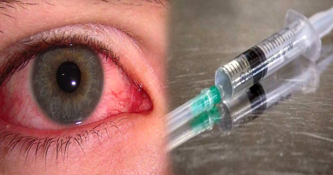 EYES-INFECTION