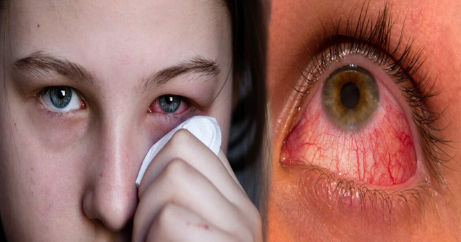 eye-infection